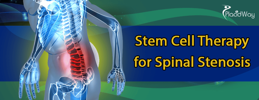 Stem Cell Therapy for Spinal Stenosis Abroad
